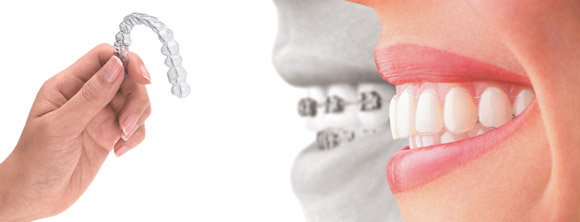 invisalign-treatment-wollongong